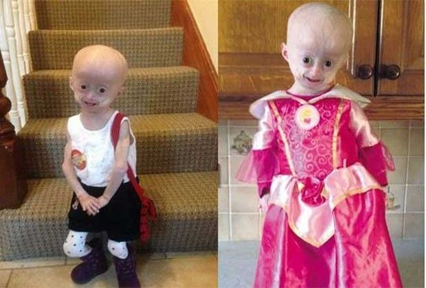 progeria-has-no-cure-650x433
