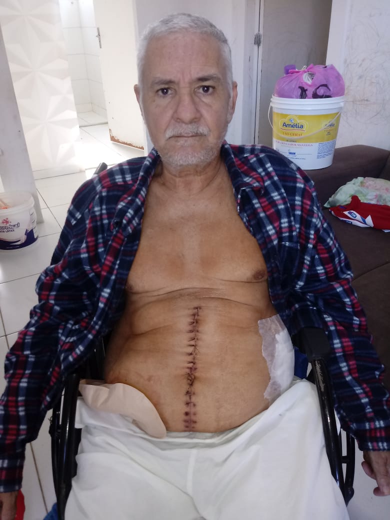Após passar por cirurgia, Chá do Lanche pede ajuda para comprar bolsas de colostomia e medicamentos