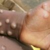 OMS descarta urgência para vacinação contra varíola dos macacos
