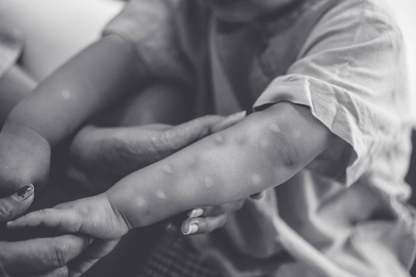 Bebê de oito meses está entre os casos suspeitos de varíola dos macacos em Ubaíra
