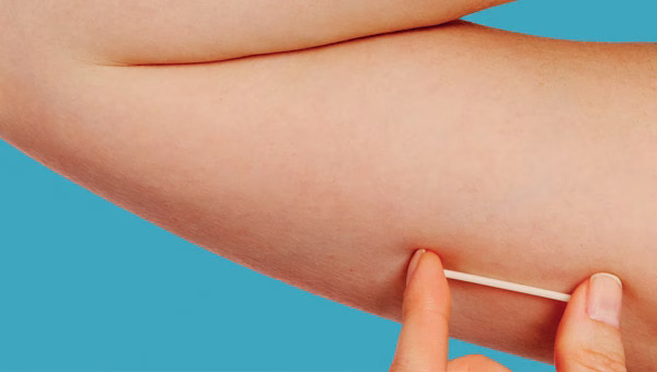 contraceptivo Implanon